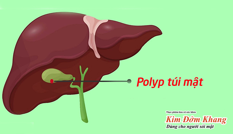 Điều trị polyp túi mật cần dựa vào tình trạng bệnh cụ thể và kích thước polyp